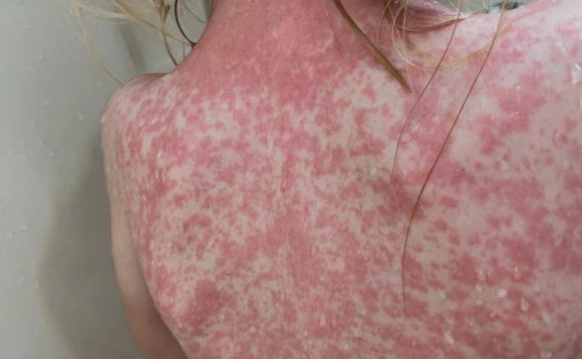 México acumula 19,084 casos confirmados y 45 defunciones debido al brote epidemiológico de sarampión registrado entre 2025 y 2026.